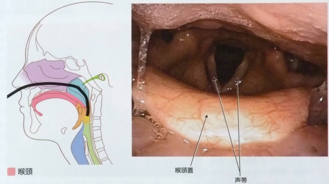 喉頭蓋炎の症状は何ですか?